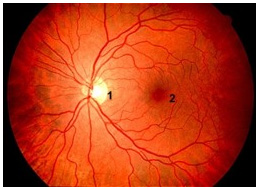 Картина глазного дна в норме: 1) Диск зрительного нерва  2) Желтое пятно (макулярная область).